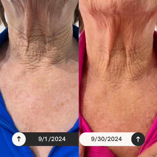 image showing before and after results of a woman using the KrX neck lift intensive firming cream for only one month. 